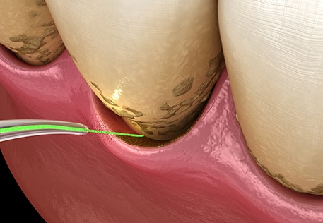 Illustration of laser periodontal therapy